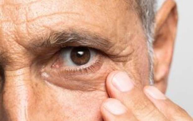 دلیل پف زیر چشم چیست؟
