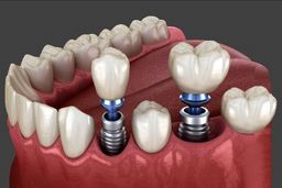 منظور از پس زدن ایمپلنت دندان چیست؟