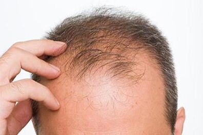 با این گیاهان از ریزش مو جلوگیری کنید