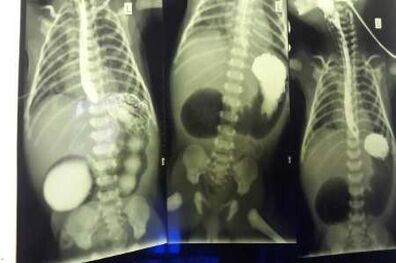 مسیرگوارشی نوزاد کرجی با عمل جراحی باز شد