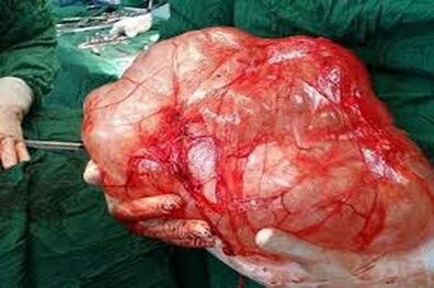 خارج کردن توده ‌5 کیلویی از کلیه یک زن