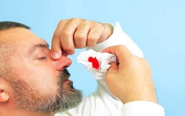 چند توصیه مهم در خصوص خونریزی بینی
