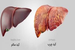 انواع بیماری کبد چرب چیست؟