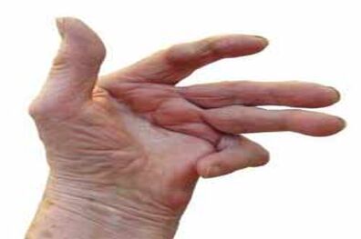 کاهش احتمال ابتلا به روماتیسم مفصلی با مصرف قرص های ضدبار داری