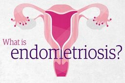 هر آنچه باید درباره اندومتریوز بدانید